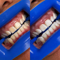 Teeth Whitening Pens