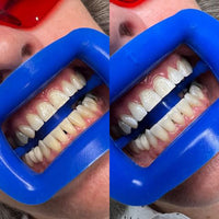 Teeth Whitening Pens