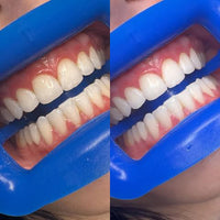 Teeth Whitening Pens